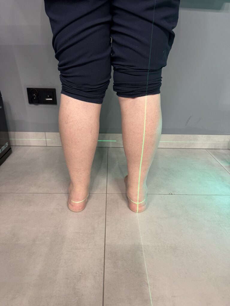 Nogi pacjenta od tyłu, od kolan w dół, z zieloną linią laserową wyznaczającą oś pięty i podudzia — ocena ustawienia tyłostopia